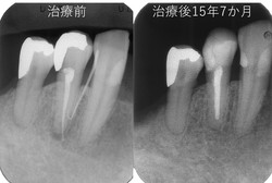 44根治前後.jpg